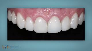 AACD Case Type V: Six or More Direct Resin Veneers