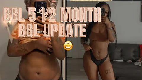 BBL 5-6 MONTHS UPDATE(305 plastic Surgery Dr. Dige...