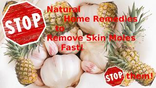 Natural Home Remedies to Remove Skin Moles Fast - Stop them!