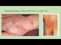 Lecture-41: Erythema Multiforme, SJ Syndrome and Toxic Epidermal Necrolysis. Rook