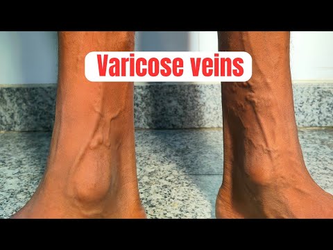 Patient evaluation & examination before laser treatment of varicose veins| varicose veins treatment Patient evaluation & examination before laser treatment of varicose veins| varicose veins treatment