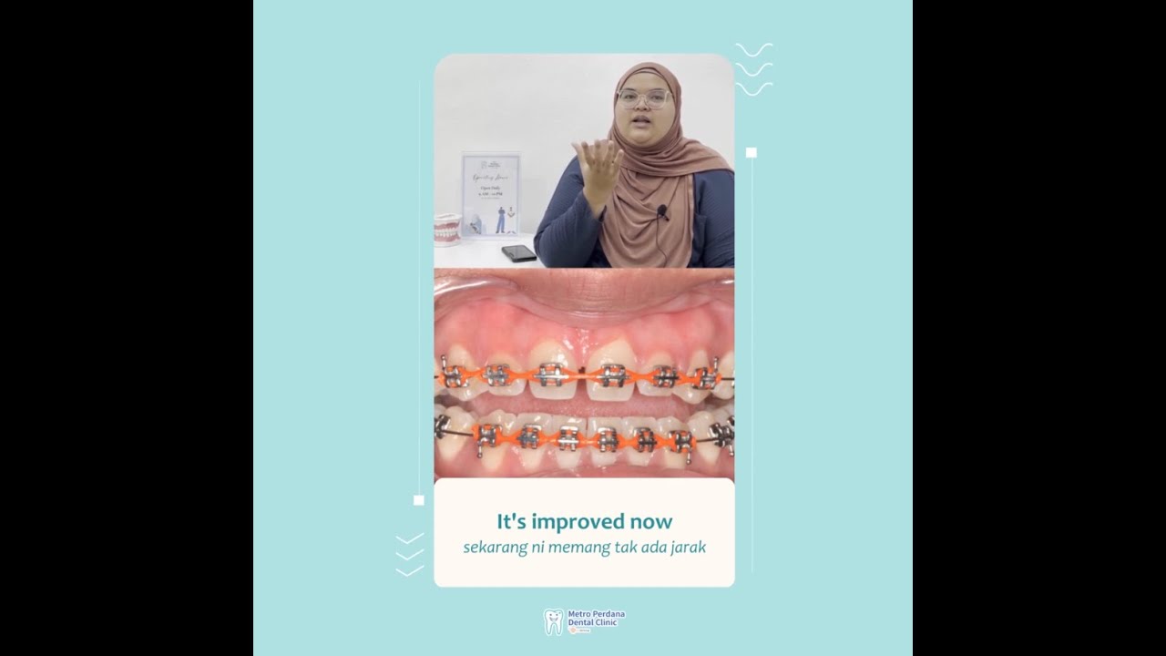 Testimonial - Conventional Braces (Spacing)