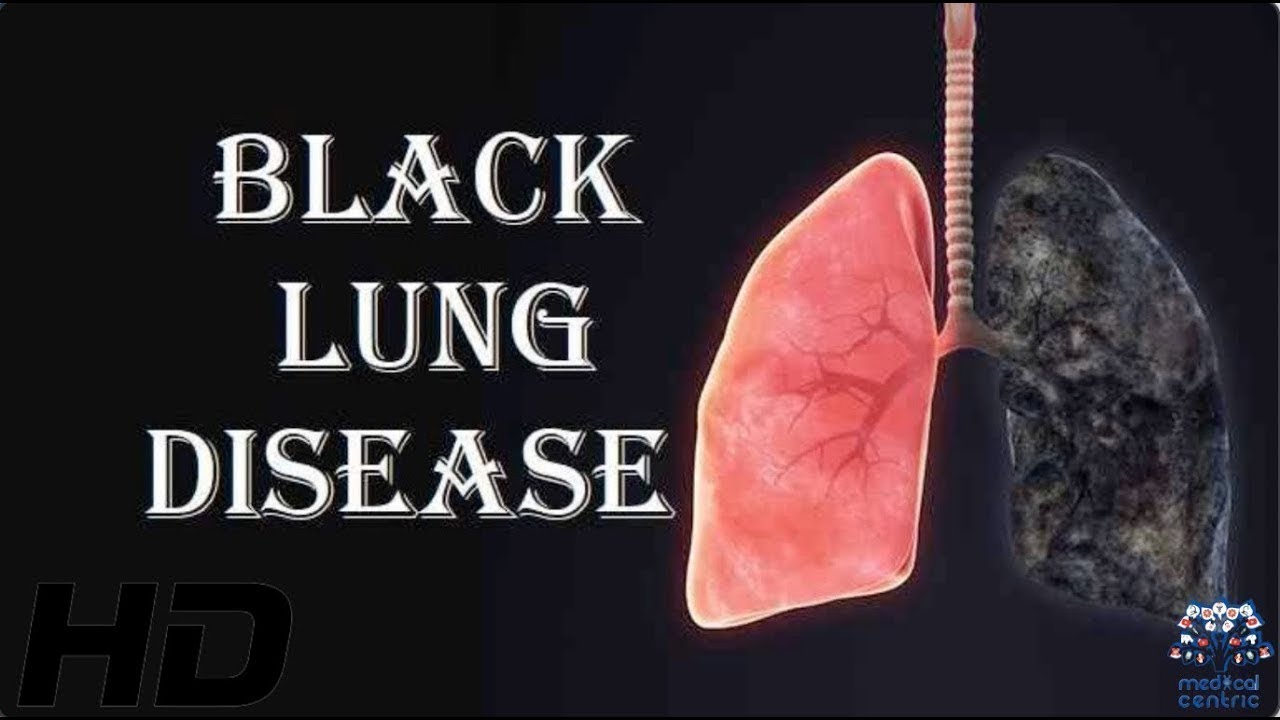 Is pneumonoultramicroscopicsilicovolcanoconiosis black lung?