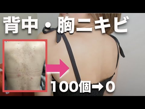 (eng)How to cure back and chest pimple