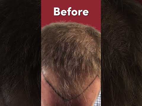 6-Month FUE Density & Hairline Progress