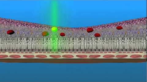 Laser Treatment for Macular Edema