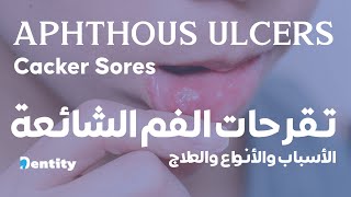 [ 2021 ] تقرحات الفم الشائعة | Aphthous Ulcers (Canker Sores)