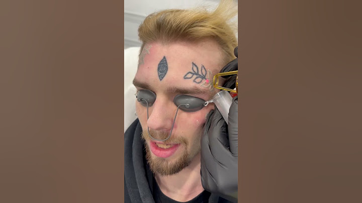Удаляем тату с лица в клинике Sokolov Laser 🤟😎