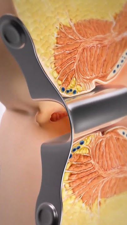 Anal Fissure Laser Surgery Treatment #viral