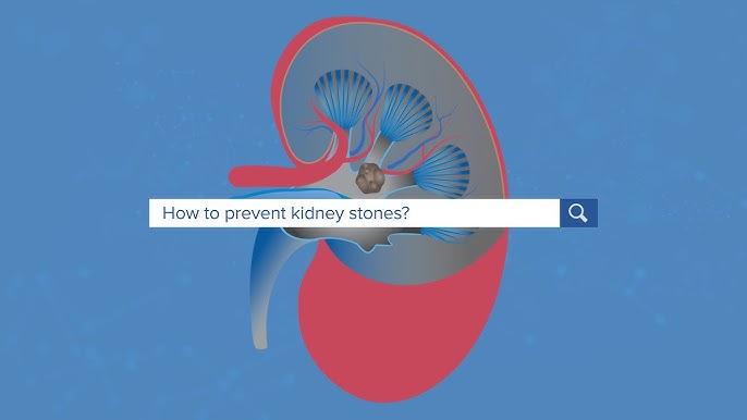 Effectively Prevent Kidney Stones Expert 2024