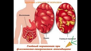 эту болезнь должен знать каждый - Перитонит эту болезнь должен знать каждый - Перитонит