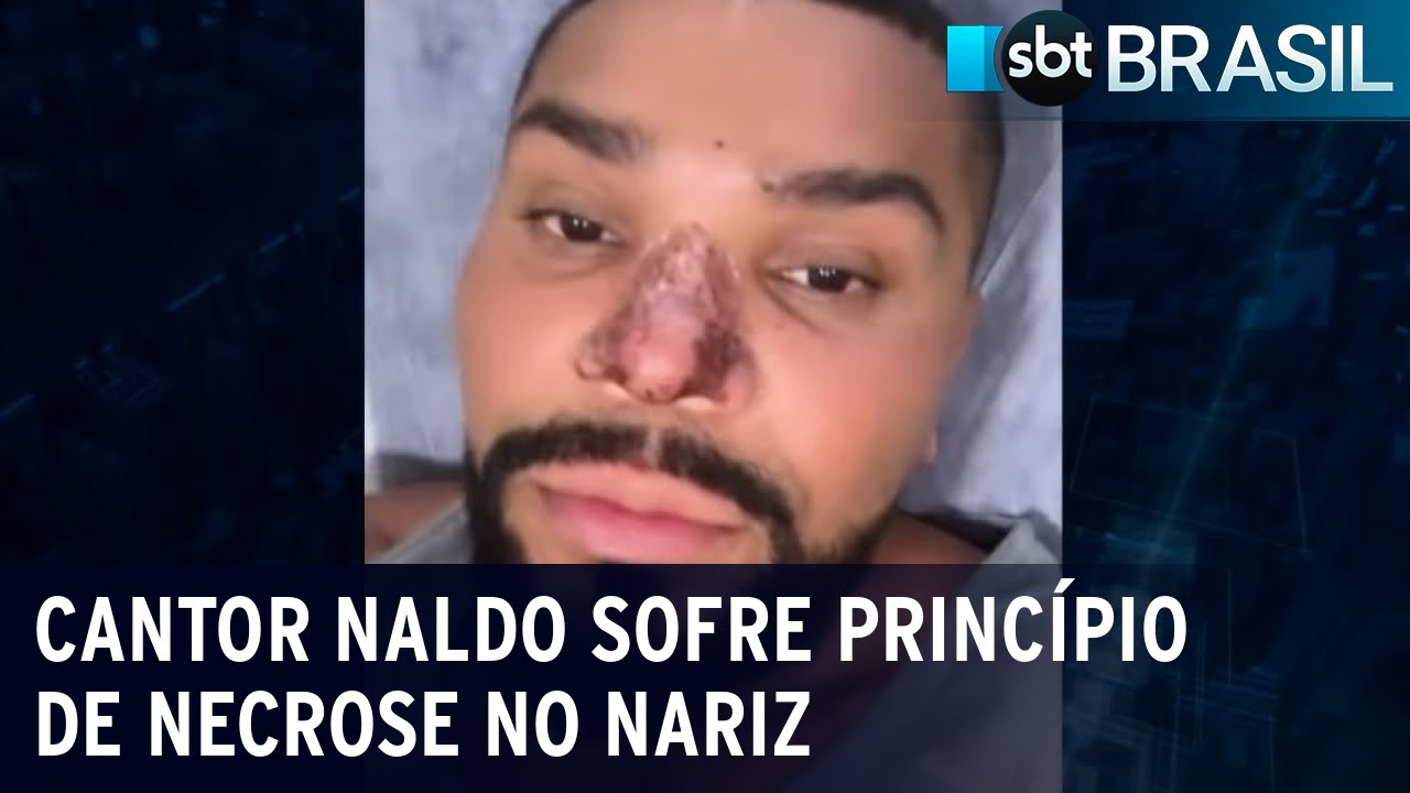 Cantor Naldo sofre princípio de necrose no nariz | SBT Brasil (30/11/22)