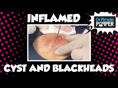 Inflamed Cyst AND Blackheads Ala Favre Racouchot CORRECTED! :)