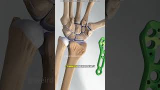 Wrist fracture repair surgery 3D animation #cosmeticsurgery #doctor #cosmeticsurgery #adventure