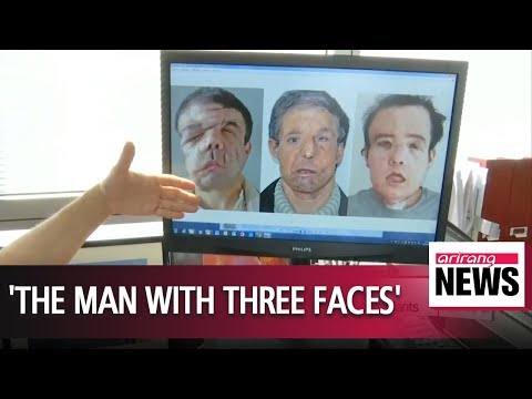 French man becomes world's first person to receive two face transplants