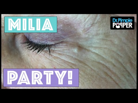 Today's Milia Extractions | Dr. Pimple Popper