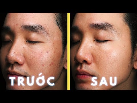 Cách Mình Trị Mụn Với Kiến Thức Skincare Tiệm Cận 0 | Trái Lê Vlog