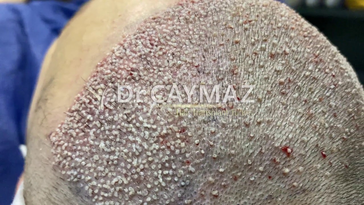 High Density Hair Transplantation