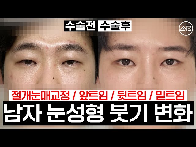 남자 눈매교정 전후 붓기 비교 | 에이비성형외과