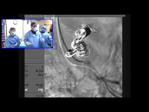 Celiac Artery Aneurysm Embolization using a Transradial Approach