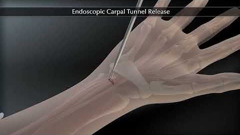 Endoscopic Carpal Tunnel Release