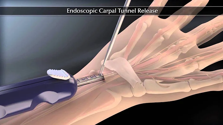 Endoscopic Carpal Tunnel Release