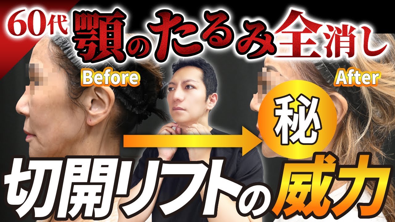 【手術体験談】60代女性のフェイス＆ネックリフト｜オンラインカウンセリング対応の症例