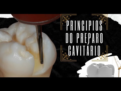 Vídeo: Os preenchimentos cavitários são necessários?