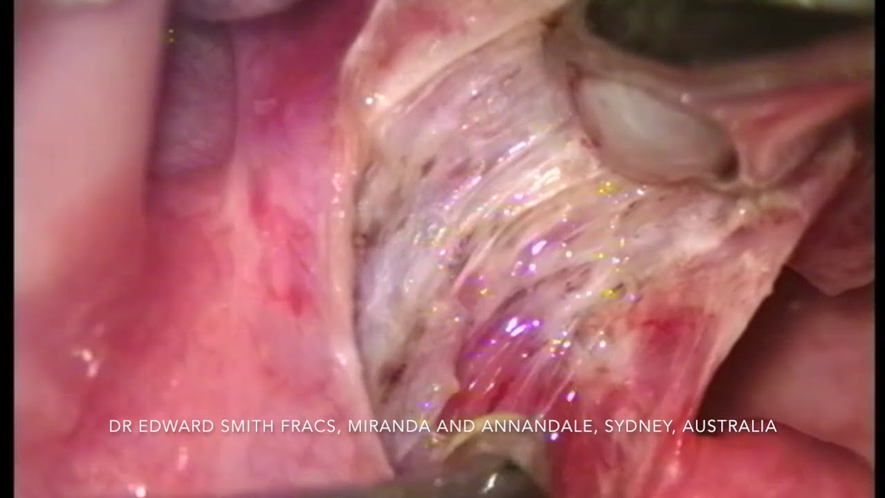 Tonsillectomy What Is A Tonsillectomy Tonsils Surgery Ent Specialist