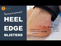 Taping to prevent heel edge blisters  blister prevention