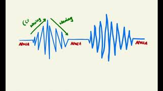 Answer - Medicine Quiz No.1 : CHEYNE-STOKES BREATHING
