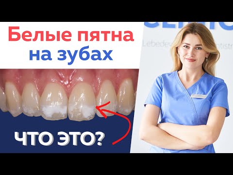 Причина белых пятен на зубах \\ Флюороз, гипоплазия эмали или кариес?