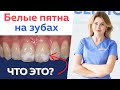 Причина белых пятен на зубах \ Флюороз, гипоплазия эмали или кариес?