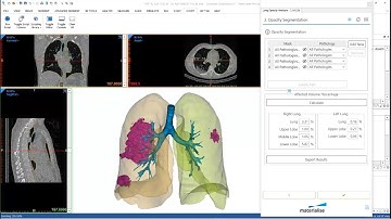 Quantify and 3D Visualize COVID-19 manifestations in CT