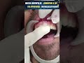 क्या इस टूटे दांत को बचाया जा सकता है ??Can this broken tooth be saved ?? #transformationofsmile