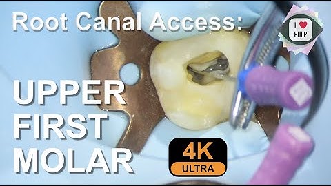 Perfect Root Canal Access Cavity Everytime! 4K resolution