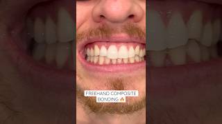 Composite bonded veneers by Dr. Sulley to create an even, proportionate smile. 🔥 #ruhdental