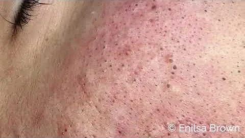 Blackheads, Whiteheads Extractions on "K" Part 1