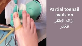 Partial toenail  avulsion    ازالة الاظفر الغائر