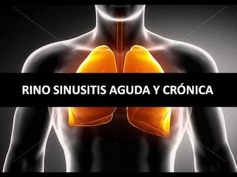 Vídeo: Predictores Clínicos De La Rinosinusitis Crónica: ¿las Guías De Práctica Clínica Canadienses Para La Rinosinusitis Aguda Y Crónica Predicen La Confirmación Por CT De La Enfermedad?