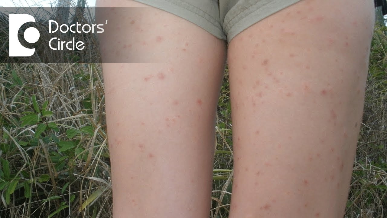 How to manage inner thigh rashes in teenagers? - Dr. Urmila Nischal 
