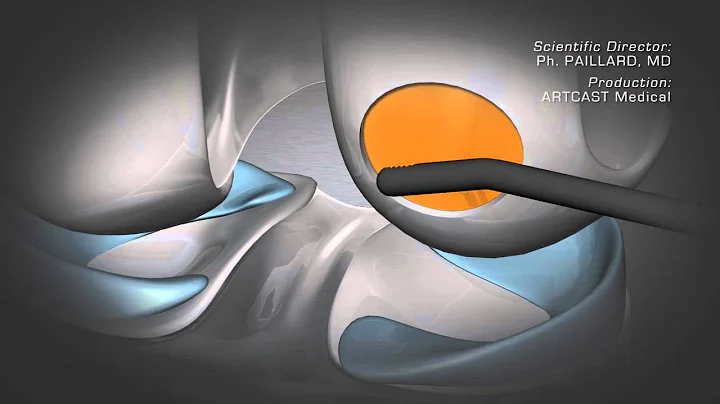 Knee Cartilage Damage