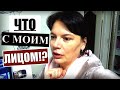 ЧТО СЛУЧИЛОСЬ С МОИМ ЛИЦОМ; ВЛОГ