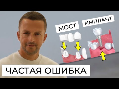 ПОСЛЕДСТВИЯ НЕОБРАТИМЫ ! Имплантат или мост -  как сделать правильный выбор?