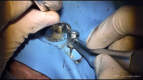 Deep margin elevation and core build up