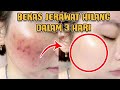 Rahasia Wajah Mulus Bebas Jerawat Hanya dalam Semalam