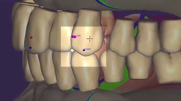exocad Video Tutorial: Full Denture Design UNIMDENT CAD CAM