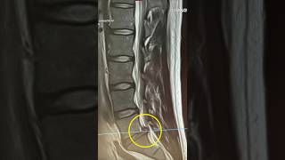 Lumbar Disc Herniation recovery at home #discherniation #discbulges #backpain #gym #sciatica #l5s1
