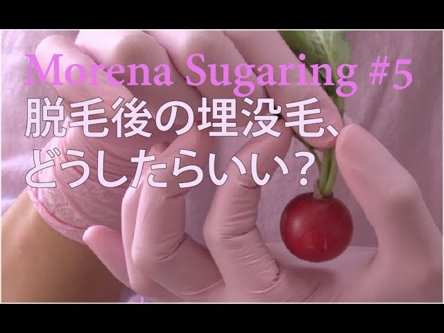 Vlog 5 脱毛後の埋没毛 どうしたらいい Youtube