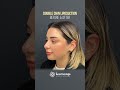 Double Chin Liposuction Before&amp;After By. Dr Burak Pasinlioğlu